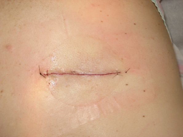 Lipoma Removal Scar