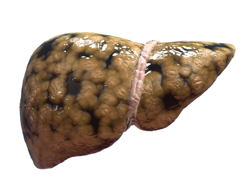 Non Alcoholic Fatty Liver Disease Naturopathic Doctor News And Review