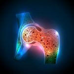 New Risk Factor for Osteoporosis: SSRIs can Impact Bone Health