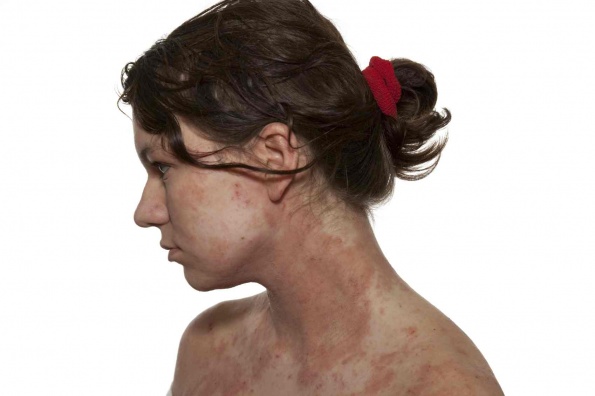 mild dermatitis herpetiformis on face