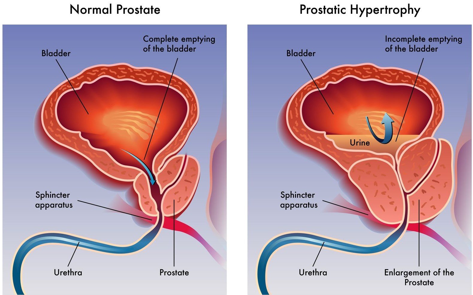 What causes enlargement of the prostate