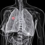 54-Year-Old Woman With Non-Small Cell Lung Cancer