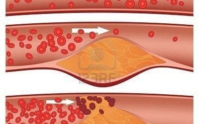 The Clinical Significance of Oxidized Low-density Lipoprotein Cholesterol