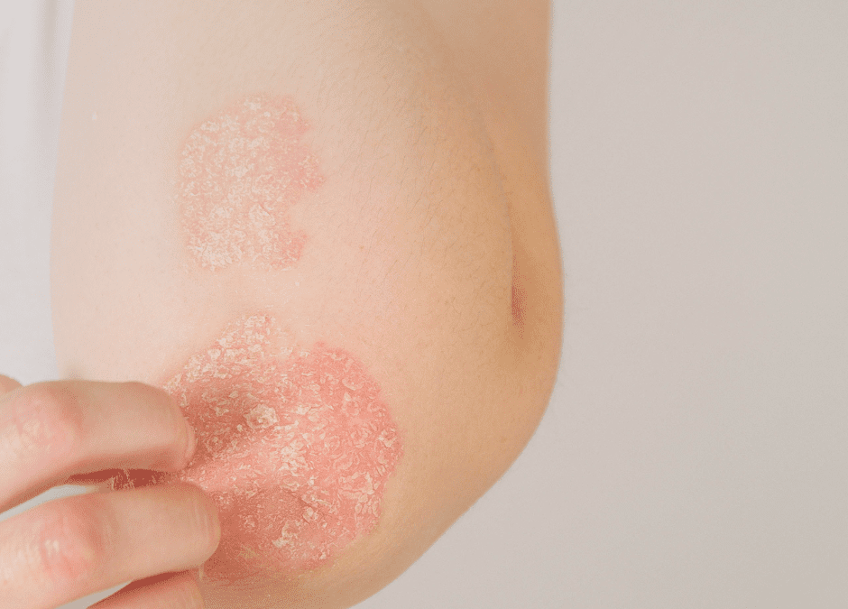 Allergies, Asthma & Eczema: Pediatric Treatment of the Atopic Triad
