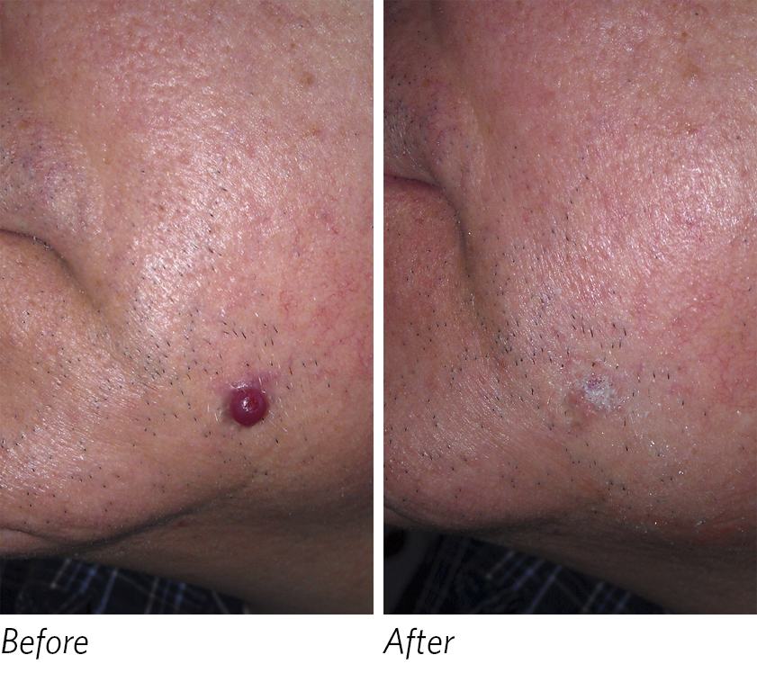 Radiofrequency Mole Removal – Naturopathic Doctor News and Review
