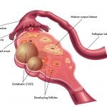 PCOS: A Leading Cause of Infertility