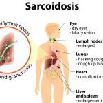 Sarcoidosis and Environmental Toxins