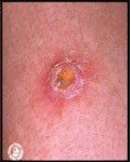 Figure 2: Skin lesion that has been diagnosed as MRSA.