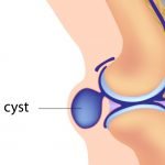 The Articular Intraosseous Cyst in Osteoarthritis: Subchondral Cysts and Traction Cysts