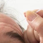 Antiaging Facial Acupuncture