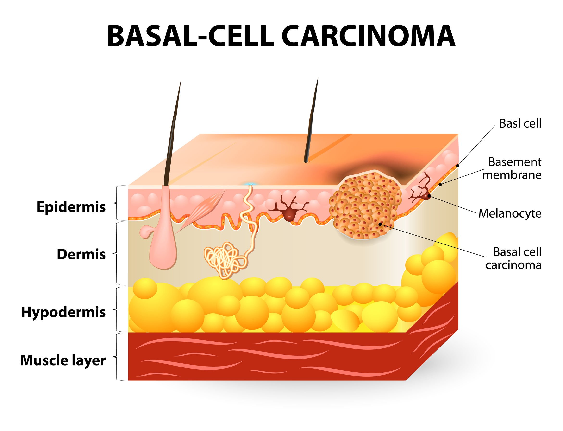 treatment for basal cell papilloma)