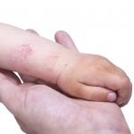Pediatric Atopic Dermatitis: Clearing the Obstacles and Addressing Psora