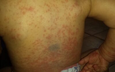 Pediatric Atopic Dermatitis: Clearing the Obstacles and Addressing Psora