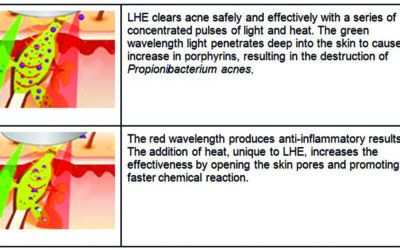 Acne Vulgaris: Treating with Light, Heat, & Energy Technology