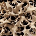 A Case Study in Osteoporosis