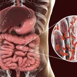 Autoimmune Disease: The Role of Gut Bacteria