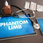 Treating Phantom Limb Pain: A Naturopathic Approach
