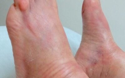 Morphea: Effective Treatment with Homeopathy