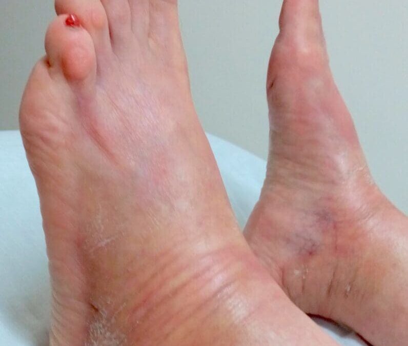 Morphea: Effective Treatment with Homeopathy
