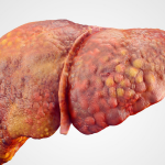 Alcoholic Cirrhosis with Ascites: A Case Report & Treatment Options