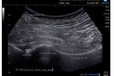 Ultrasound-Guided Injections: Applications for Musculoskeletal Conditions
