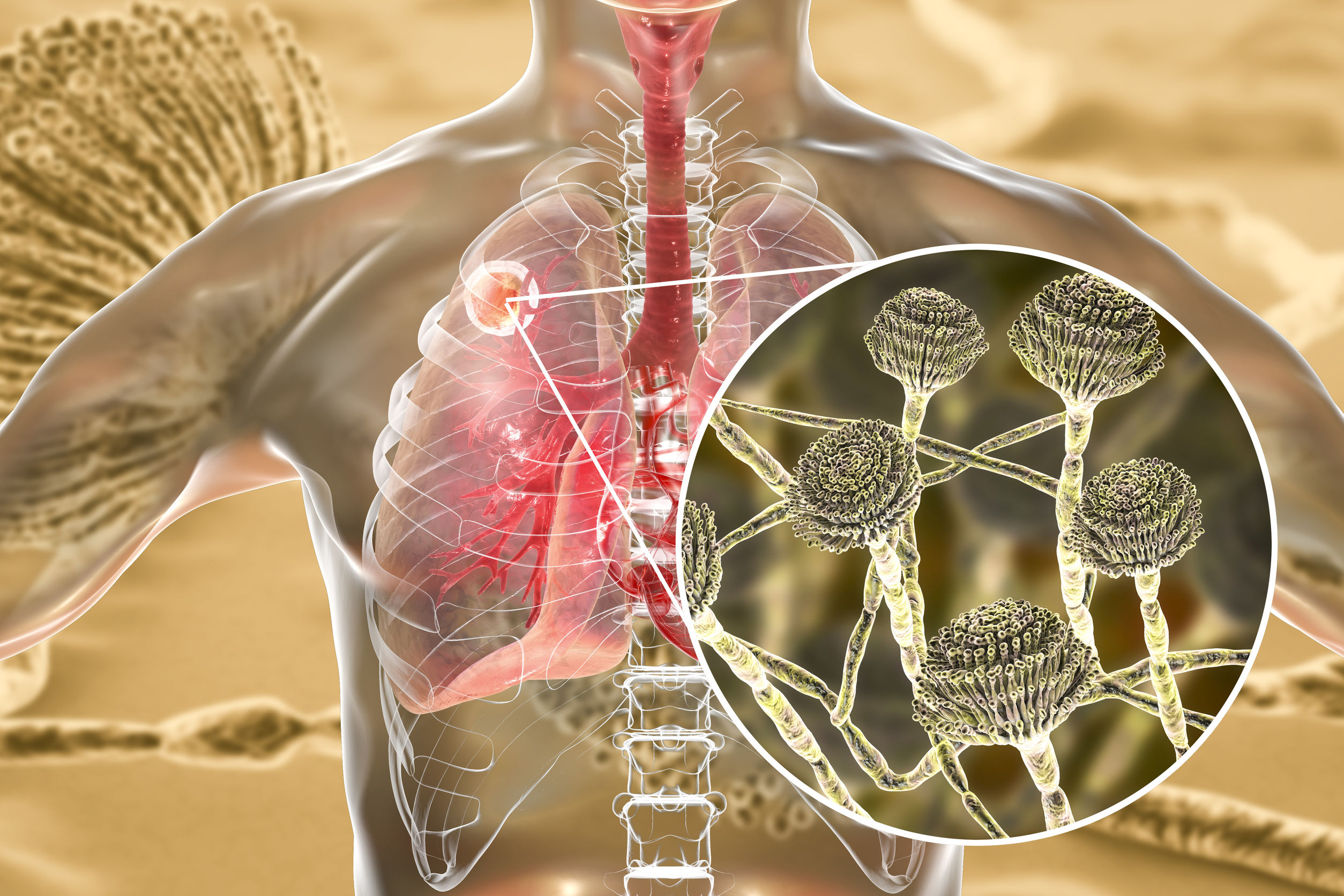 what is the life expectancy of a stage 4 lung cancer patient