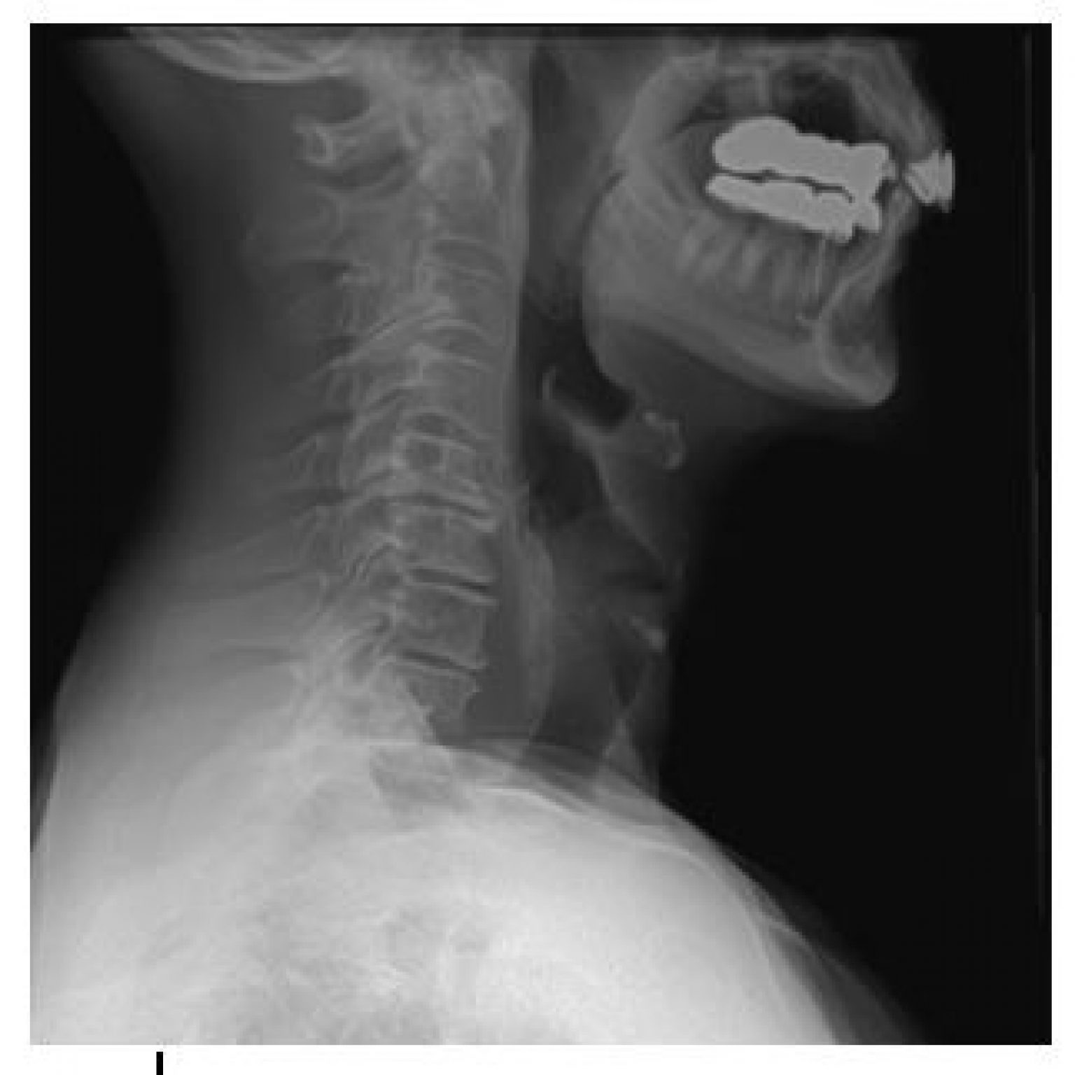mouth and skull x ray of peek a poo