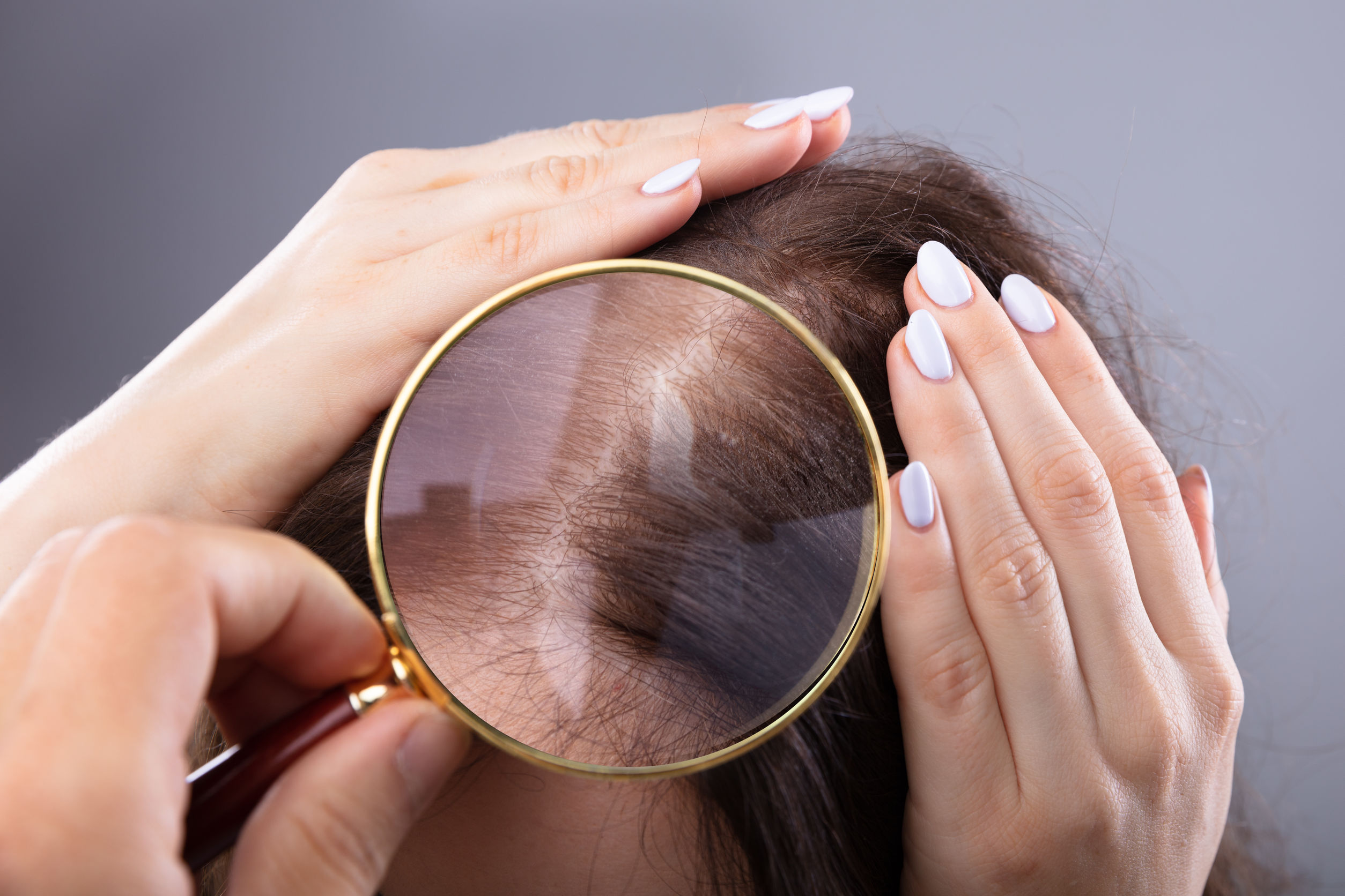 Stress-Induced Hair Loss: Benefits from a Standardized Nutraceutical –  Naturopathic Doctor News and Review