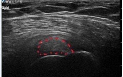 Rotator Cuff Calcific Tendinitis: A Case of US-Guided Single Needle Aspiration & Lavage