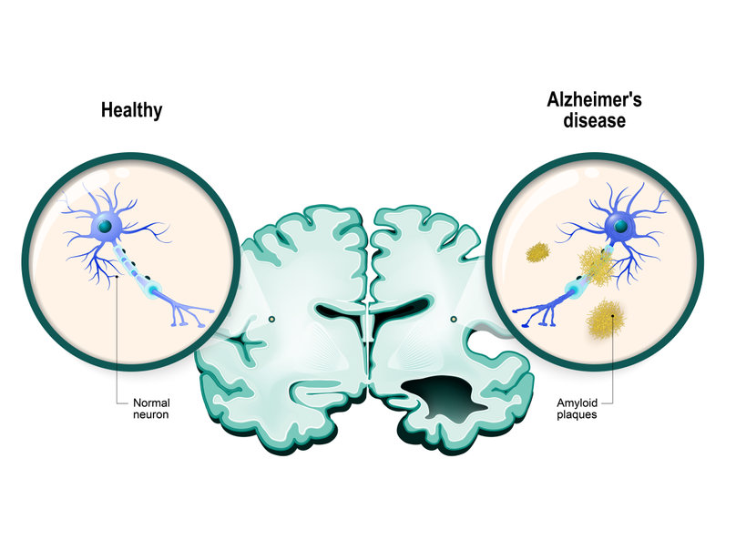  Cholesterol in Brain Regulates Alzheimer’s Plaquing