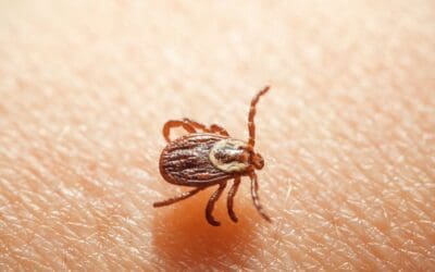 In the Thick of It: Diagnosis and Treatment for Venous Form of Thoracic Outlet Syndrome with Comorbid Tick-Borne Infections