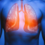 Addressing Lung Failure Earlier to Prevent COPD