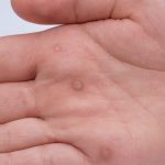 Homeopathy Kisses Warts Goodbye: A Gentle Alternative to Conventional Wart Treatments