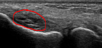 Orthobiologics and Epicondylosis: Tendon Healing Using Microfragmented Adipose Tissue and PRP