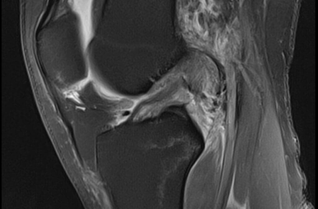 ACL Healing Without Surgery: Three Acute Complete Ruptures Treated with Regenerative Injection