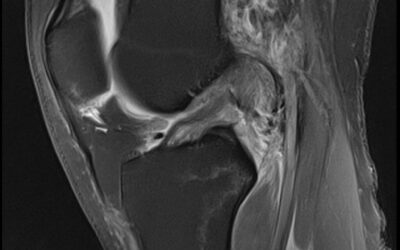 ACL Healing Without Surgery: Three Acute Complete Ruptures Treated with Regenerative Injection