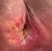 Topical Calendula Oil for Cancer Pain: An Opioid-Sparing Analgesic Approach in Recurrent Anal Squamous Cell Carcinoma
