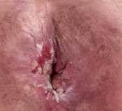 Figure 2. Post-Intervention Clinical Photograph of the Perianal Region (Day 17)