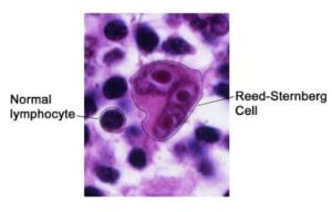 Integrative Supportive Quality of Life Care in Classic Hodgkin Lymphoma Following COVID-19 Infection: A Case Report
